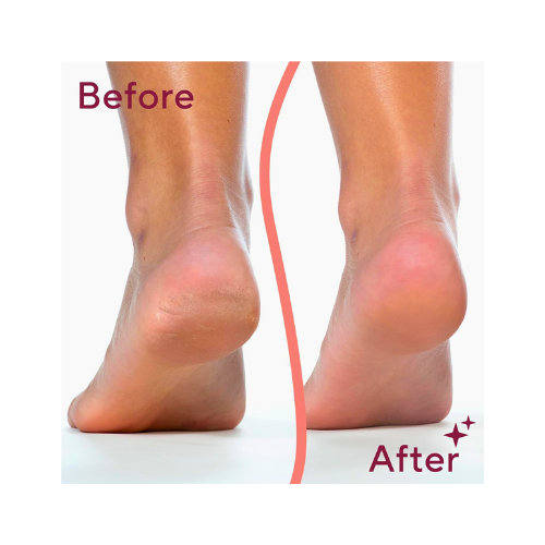 Electric Pedicure Foot File – Rechargeable Callus Remover for Smooth Feet - megamartuae