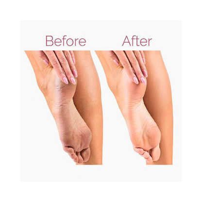 Electric Pedicure Foot File – Rechargeable Callus Remover for Smooth Feet - megamartuae